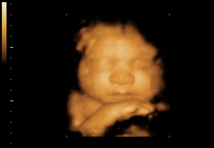 3D ultrasound image at 35 weeks